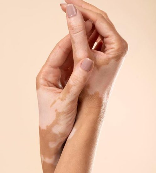 young-woman-showing-her-vitiligo-skin-parts